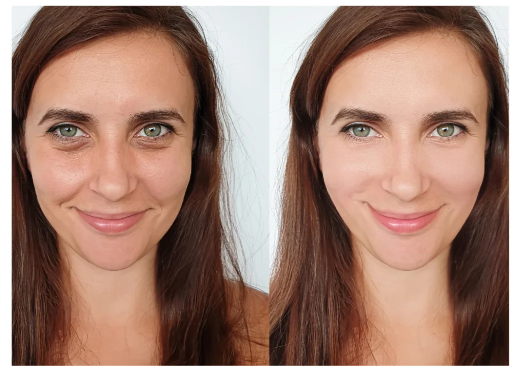 Before and After Botox