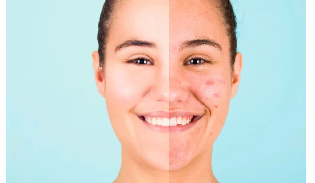 Lasting of Botox