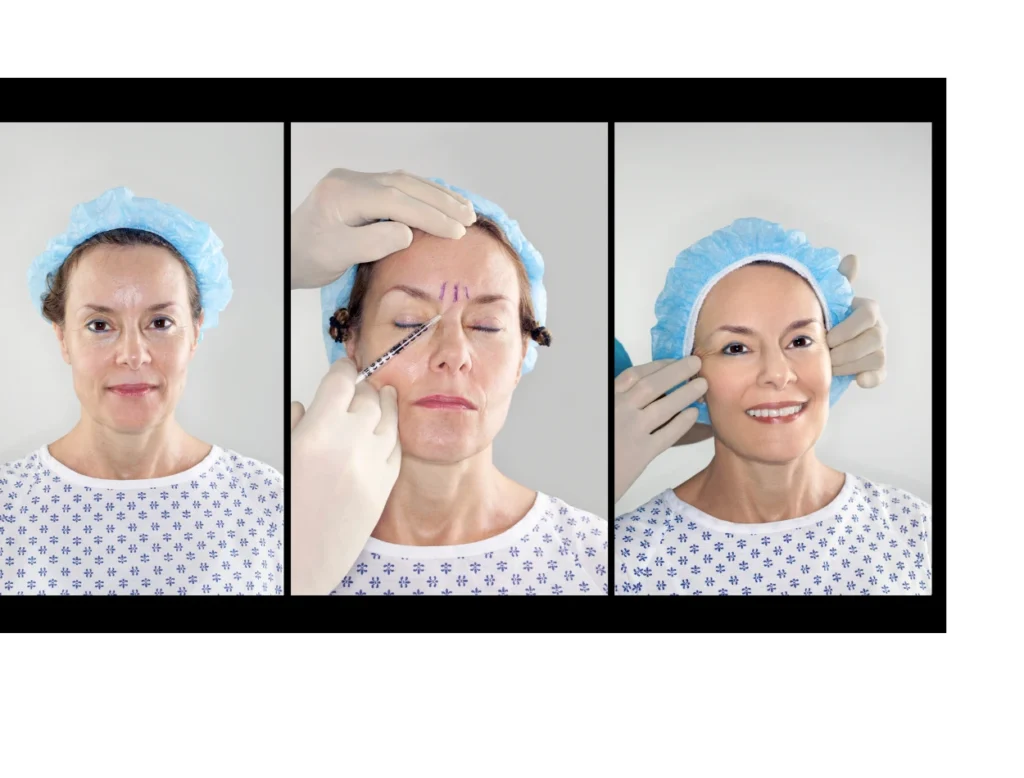 Long Lasting Botox