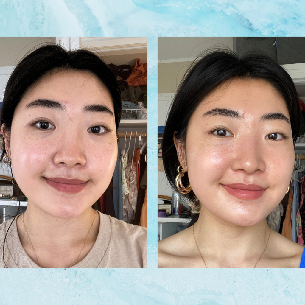 Are Hydrafacials Worth It