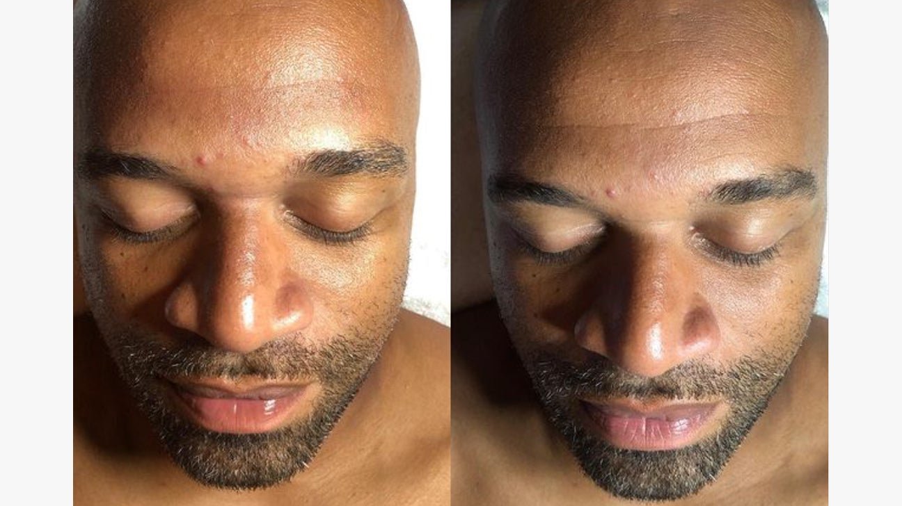 Do Hydrafacials Work