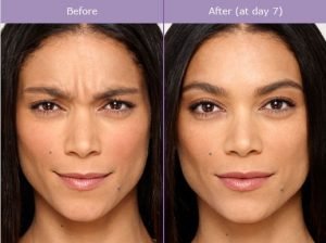 Does Botox for Migraines Change Your Face