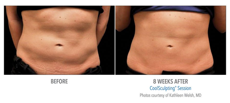 Does Coolsculpting Help Show Abs