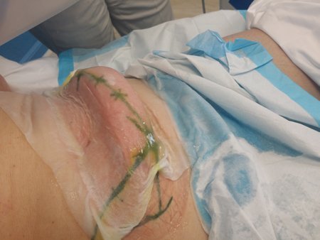 Does Coolsculpting Hurt