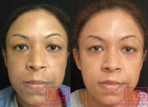 Does Microneedling Tighten Skin