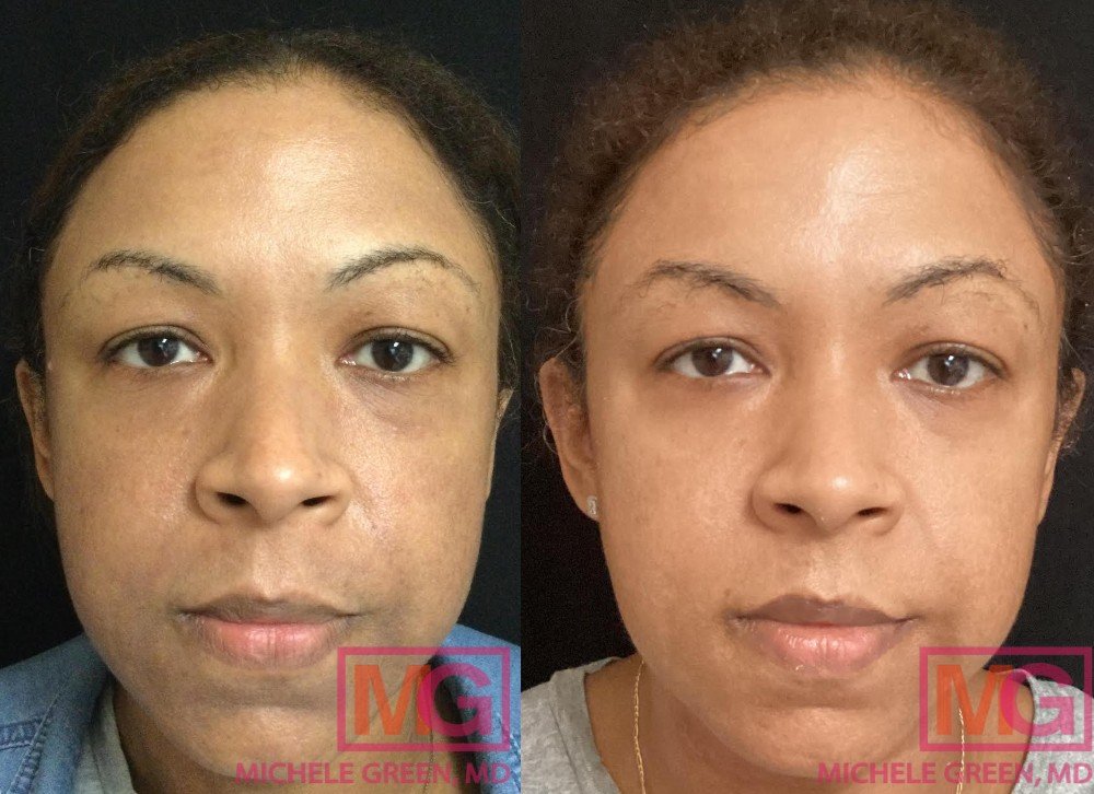 Does Microneedling Tighten Skin