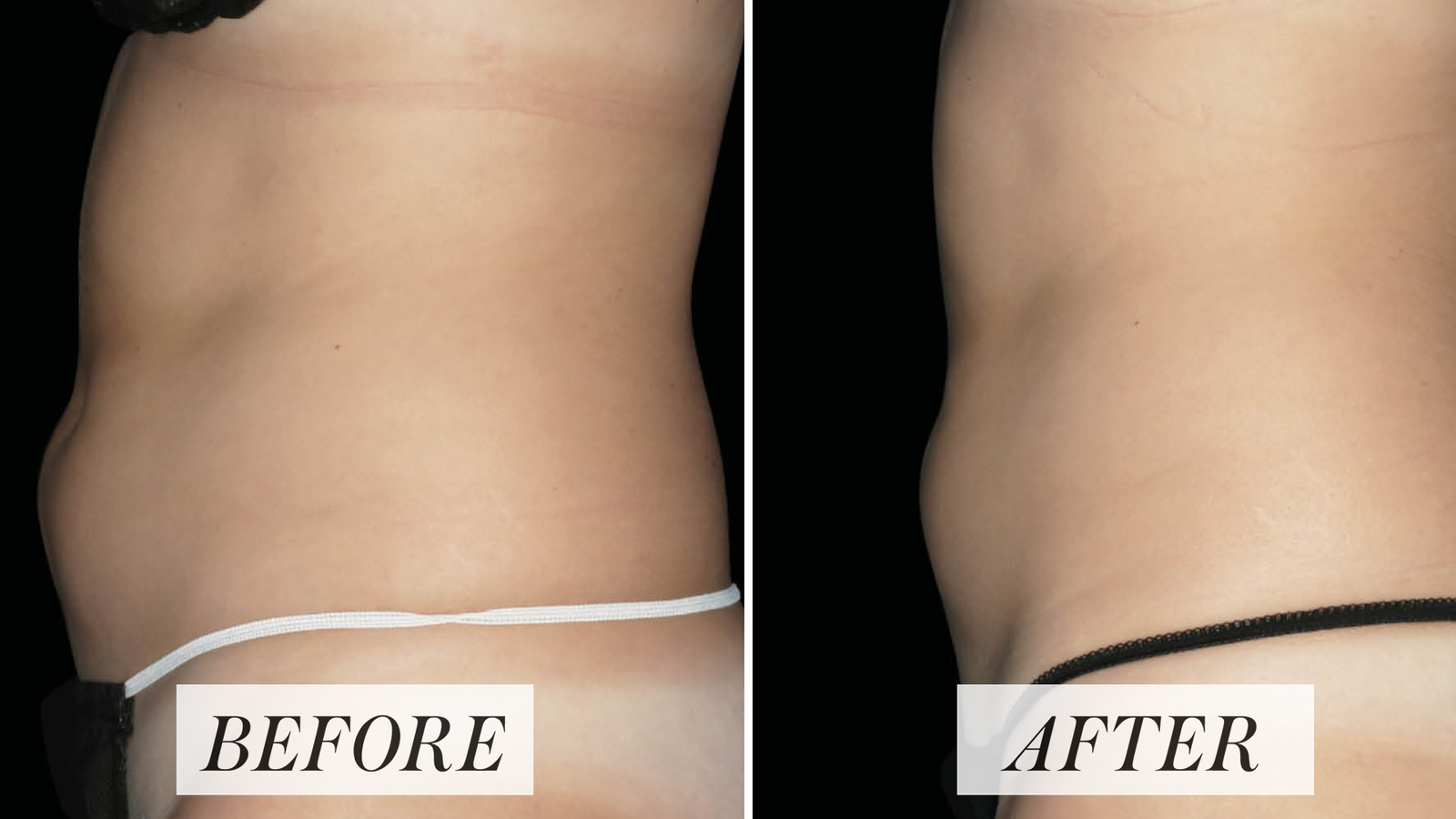 How Does Emsculpt Work