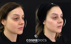 How Long Do Cheek Fillers Last