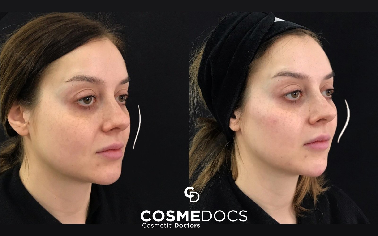 How Long Do Cheek Fillers Last