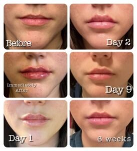 How Long Do Lip Fillers Last