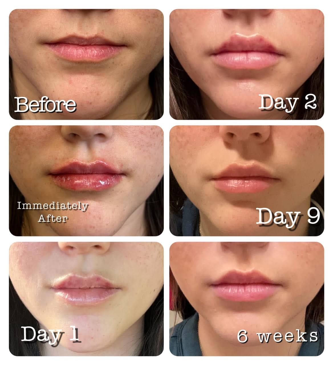 How Long Do Lip Fillers Last