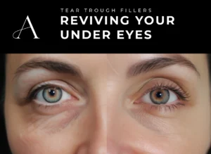 How Long Do under Eye Fillers Last