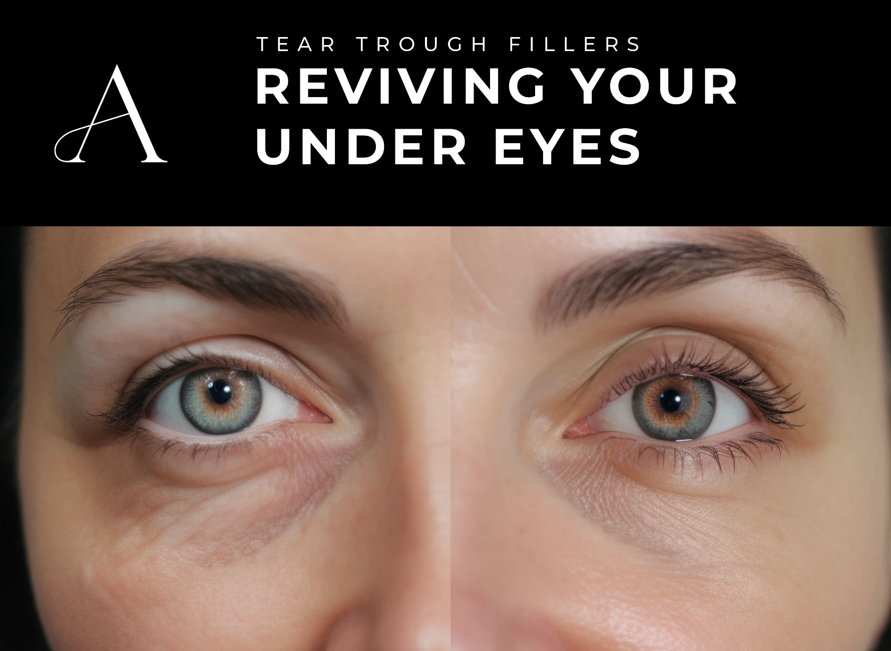 How Long Do under Eye Fillers Last