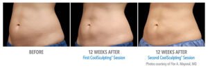 How Long Does Coolsculpting Last
