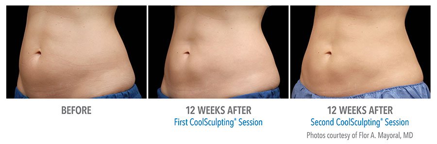 How Long Does Coolsculpting Last