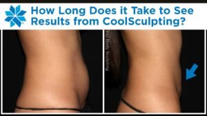 How Long Does Coolsculpting Take