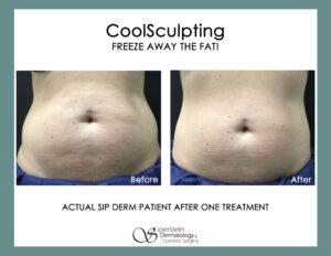 How Long Does Coolsculpting Take to Work
