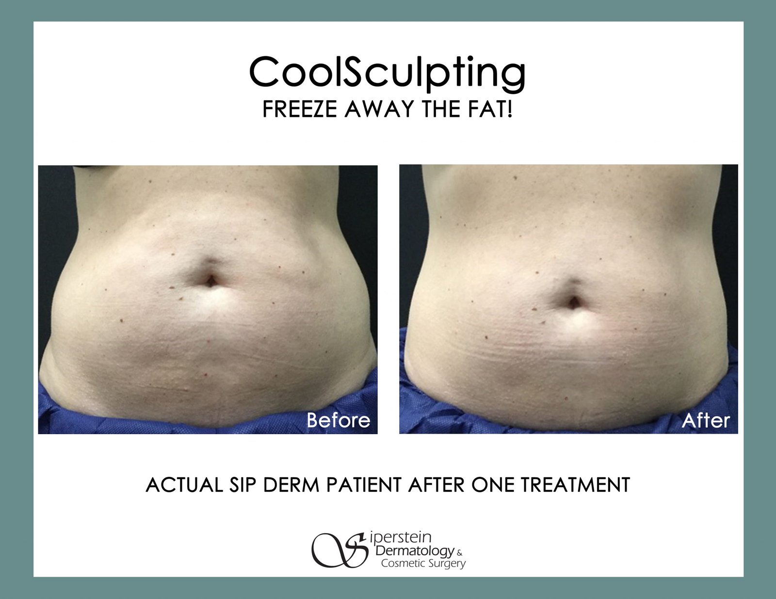 How Long Does Coolsculpting Take to Work