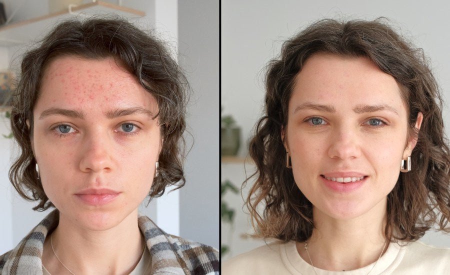 How Long Does Microneedling Last