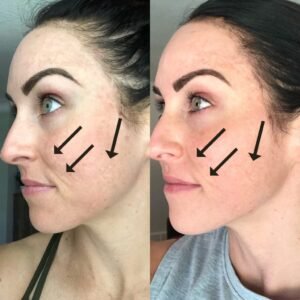 How Long Does Microneedling Take