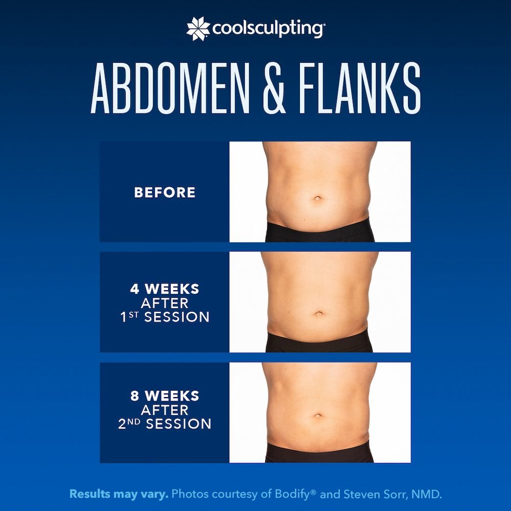 How Many Sessions of Coolsculpting for Stomach