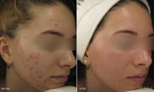How Much Microneedling
