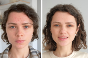 How Often Can You Do Microneedling