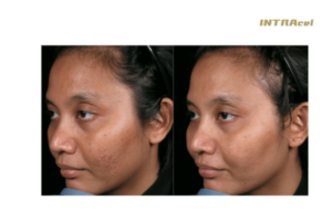 How Often to Microneedle