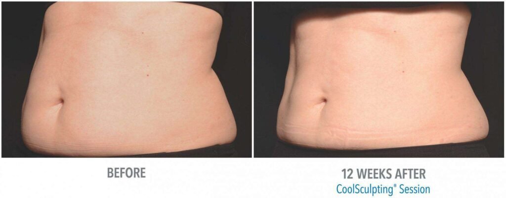 Is Coolsculpting Permanent