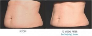 Is Coolsculpting Permanent