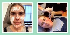 Is Microneedling Painful