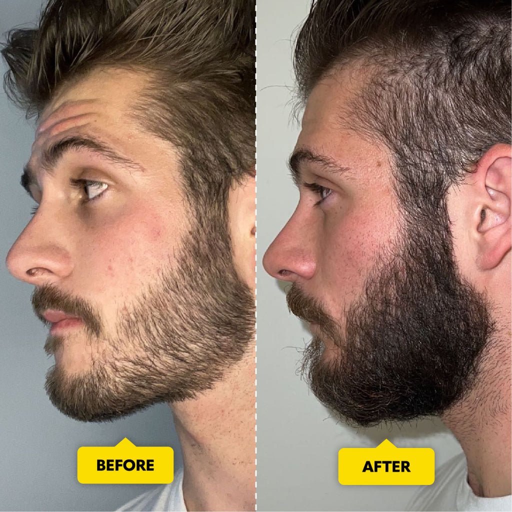 What Does Microneedling Do to a Beard