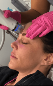 What is Rf Microneedling