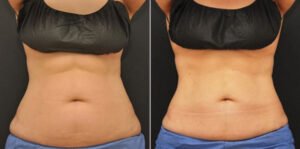 What is the Cost of Coolsculpting