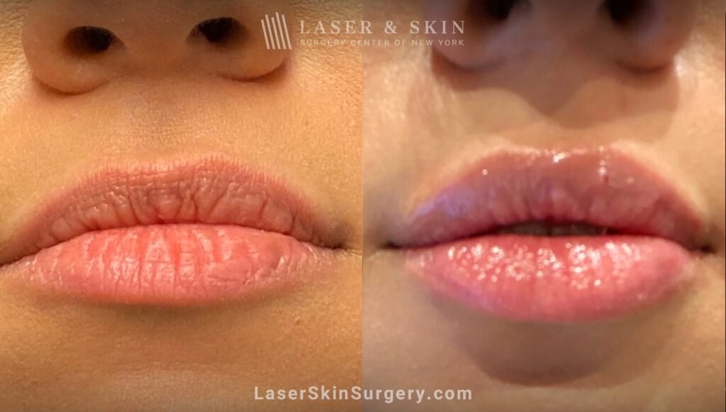 What Not to Do After Lip Fillers