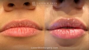 What Not to Do After Lip Fillers