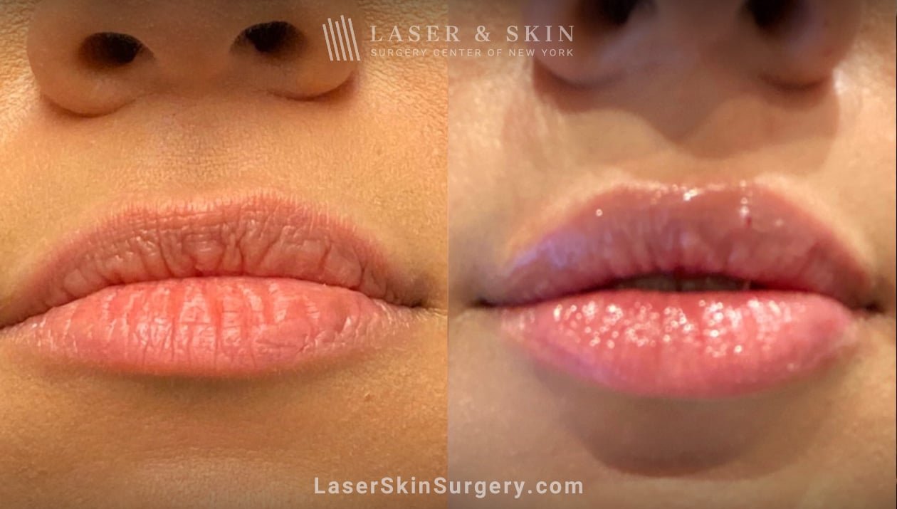 What Not to Do After Lip Fillers
