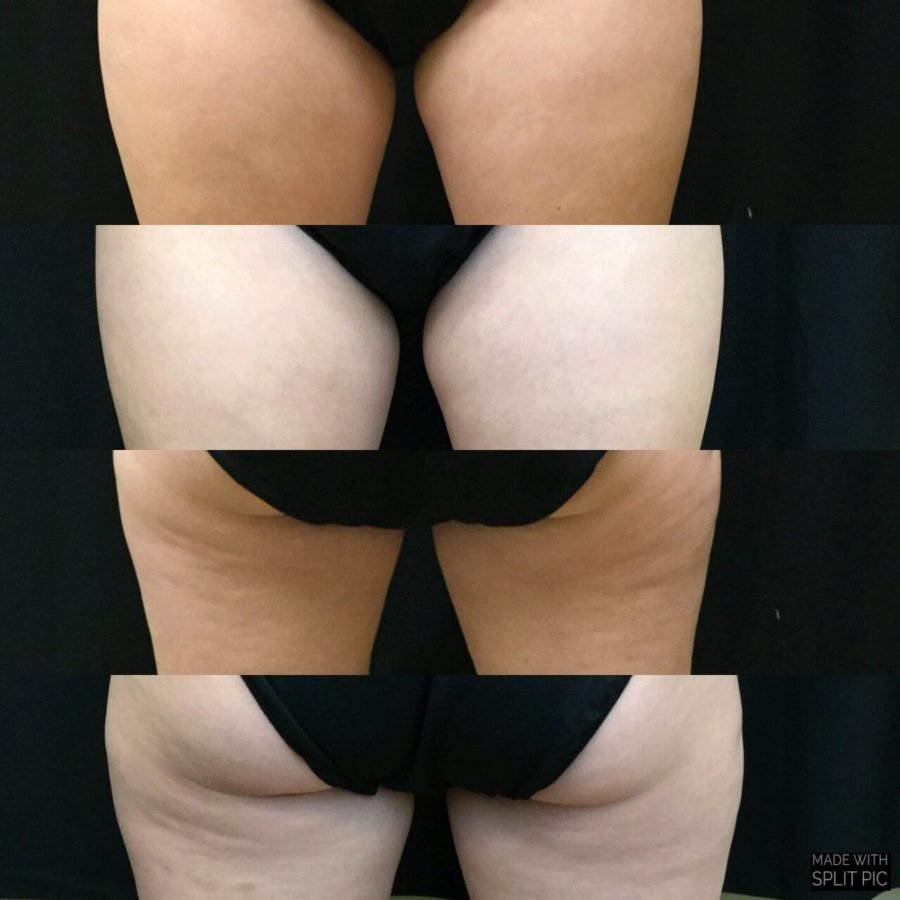 Which is Better Coolsculpting Or Sono Bello