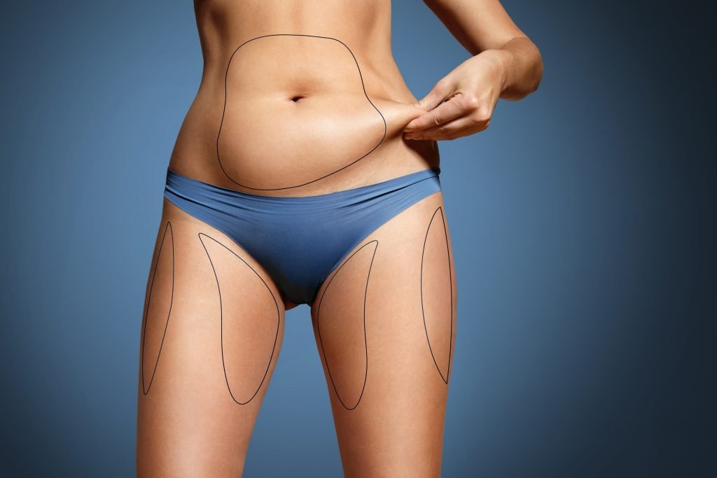 Will Insurance Cover Coolsculpting
